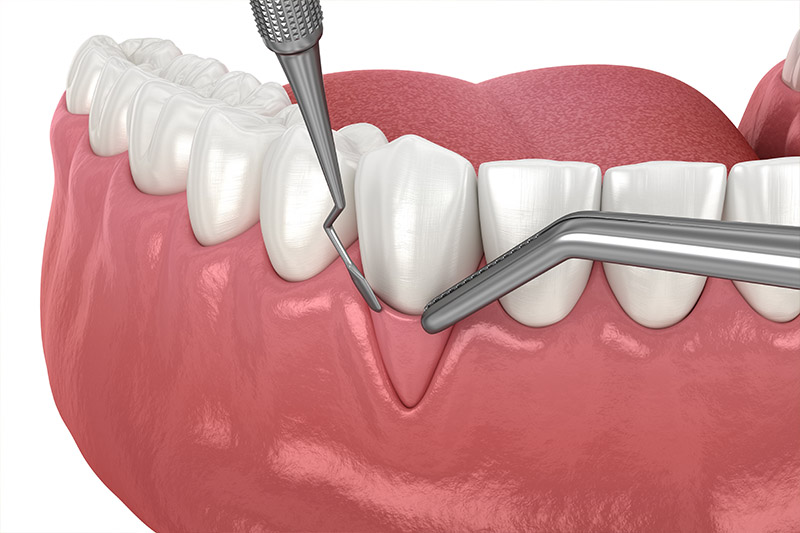 Bone Grafting in San Jose