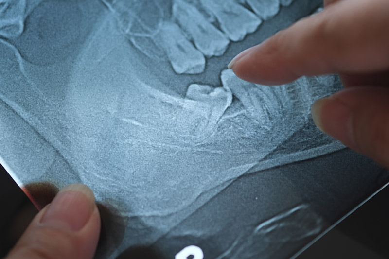 Tooth Extraction Dentist San Jose